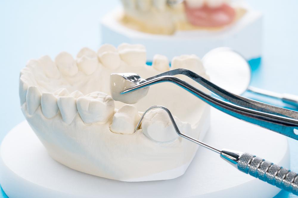 mouth mold with dental tool | tooth extraction mesquite tx