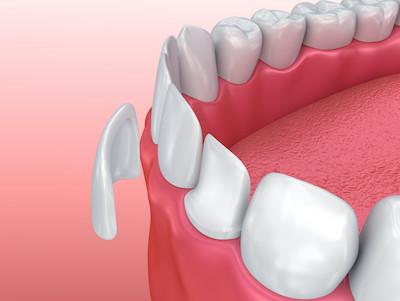 dental veneers in mesquite ct