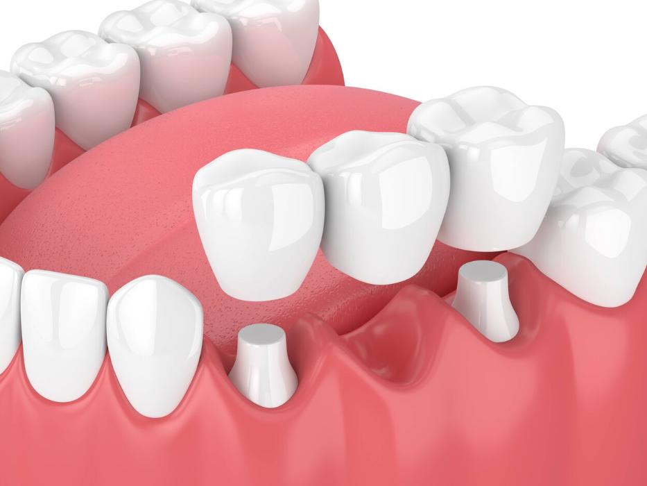 illustration of dental bridge in mesquite 
