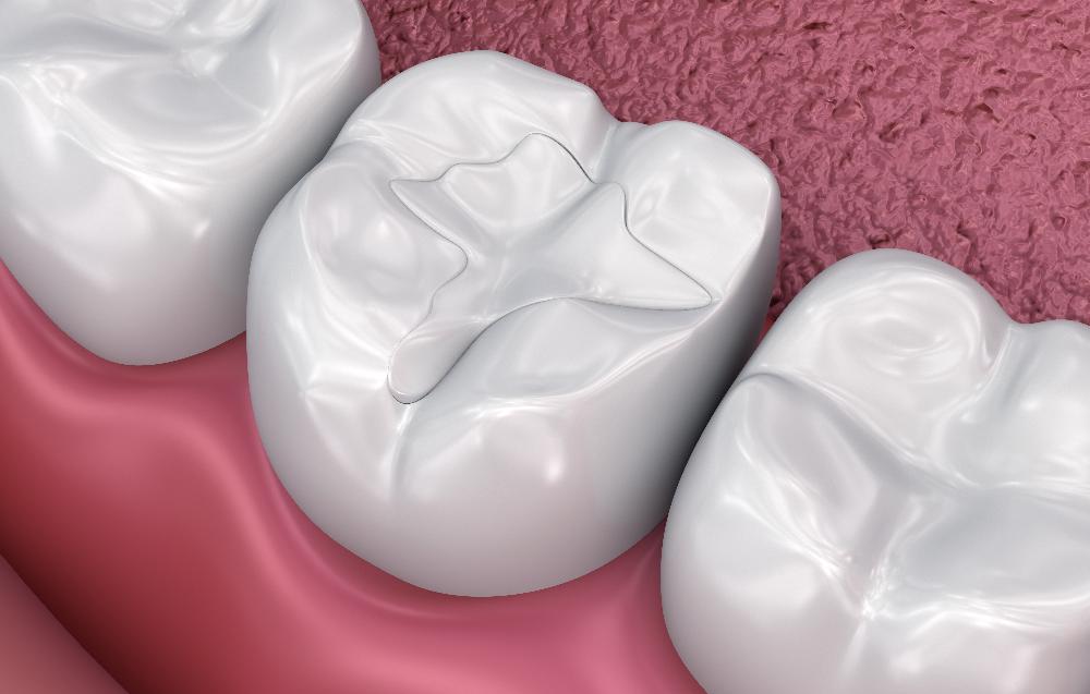 close up of tooth-colored filling on tooth | tooth-colored fillings mesquite tx