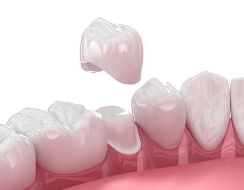 close up of crown on tooth | dental crowns mesquite tx