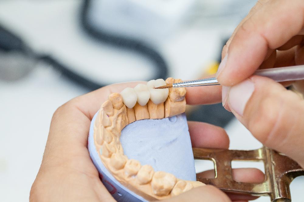 dental bridge in jaw close up | dental brisges mesquite tx