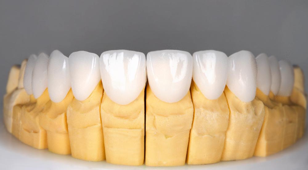 porcelain veneers in mouth mold | veneers mesquite tx