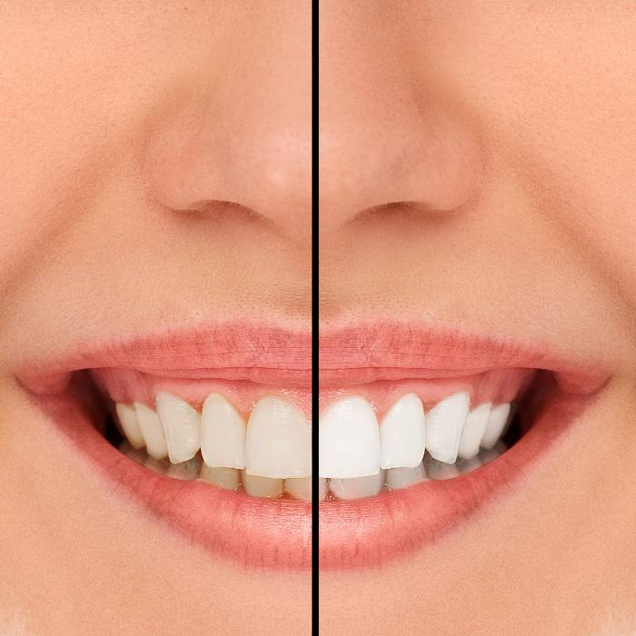 before and after teeth whitening | teeth whitening mesquite tx