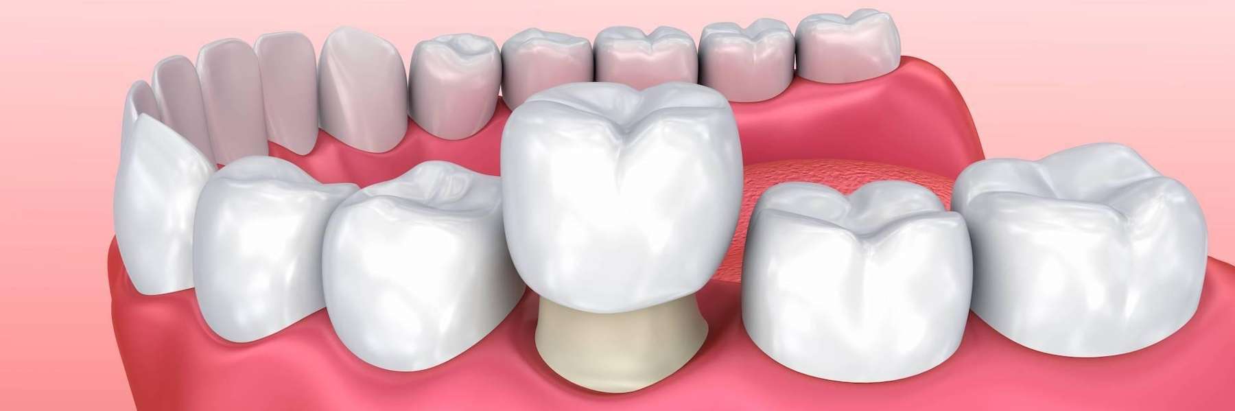 close up of dental crown on tooth | cosmetic dentist mesquite tx