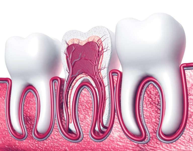 close up of root canal infection | root canal mesquite tx
