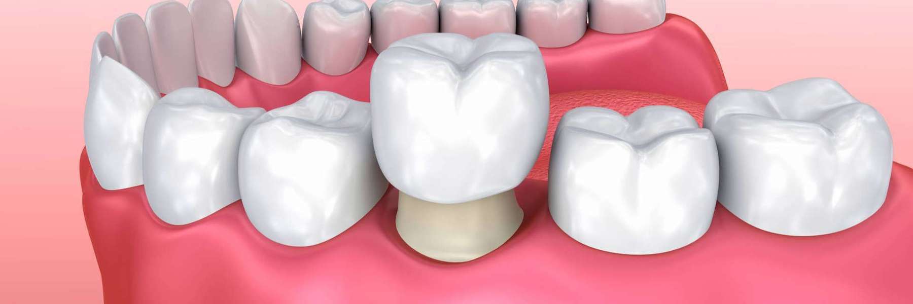 dental crown places on one tooth | dentist mesquite tx